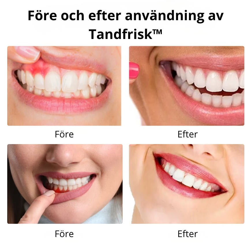 Tandfrisk™ – Vitare tänder & starkare tandkött på 7 dagar