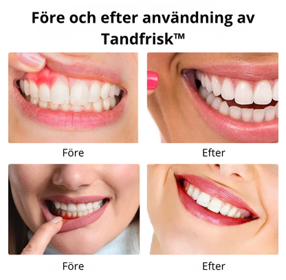 Tandfrisk™ – Vitare tänder & starkare tandkött på 7 dagar