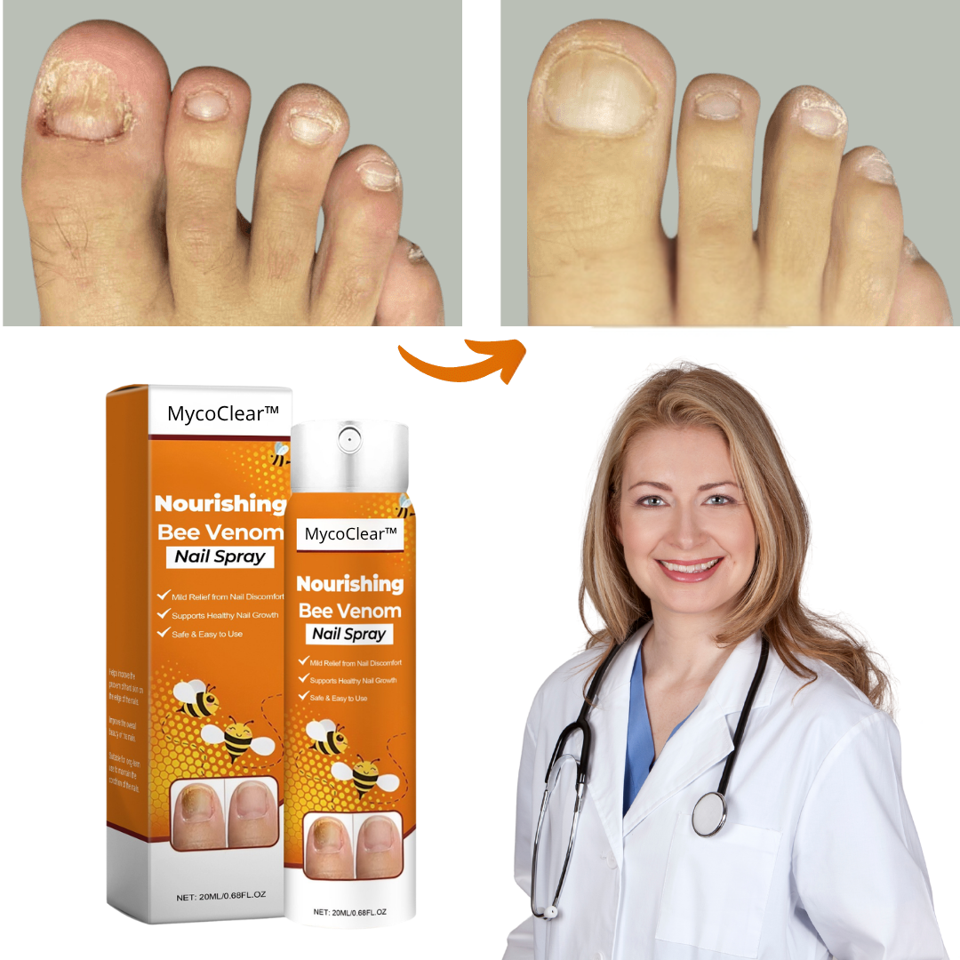 MycoClear™  - Spray Hjälper mot nagelsvamp